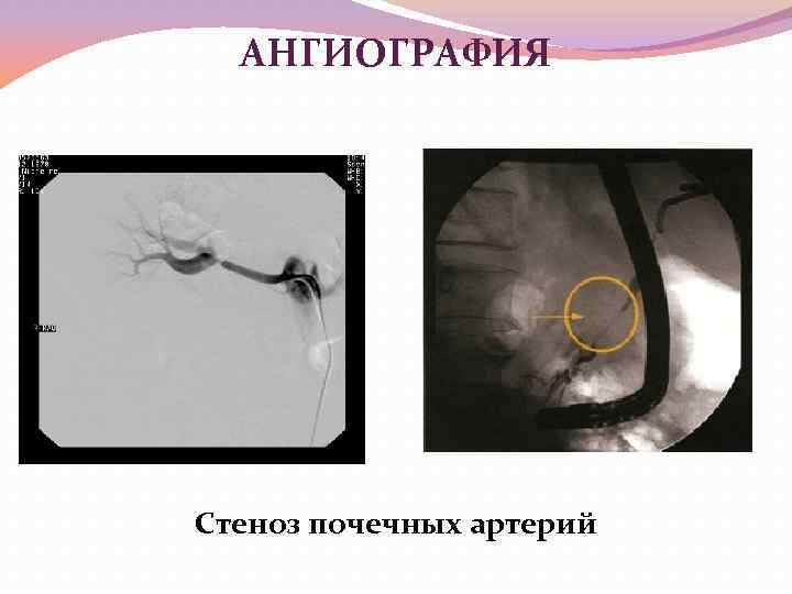 АНГИОГРАФИЯ Стеноз почечных артерий 