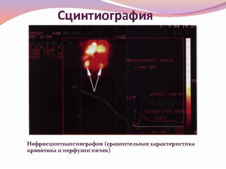 Сцинтиография Нефросцинтиангиография (сравнительная характеристика кровотока и перфузии почек) 