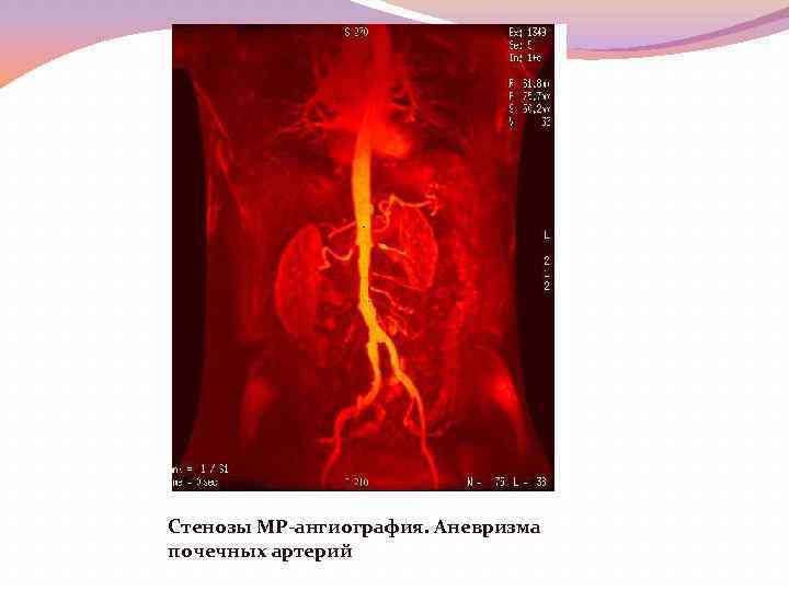 Стенозы МР-ангиография. Аневризма почечных артерий 