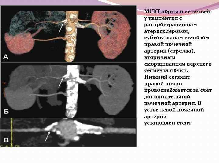 МСКТ аорты и ее ветвей у пациентки с распространенным атеросклерозом, субтотальным стенозом правой почечной