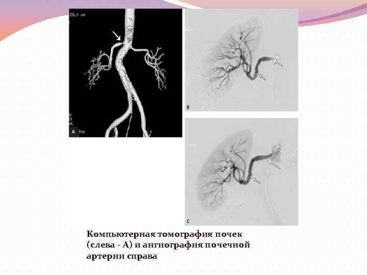 Почечная ангиография презентация