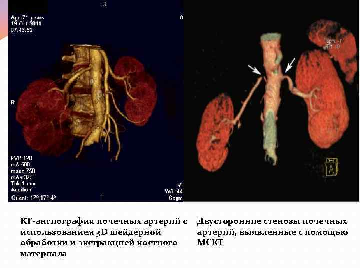 КТ-ангиография почечных артерий с использованием 3 D шейдерной обработки и экстракцией костного материала Двусторонние