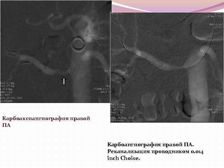 Карбоаксиангиография правой ПА Карбоангиография правой ПА. Реканализация проводником 0. 014 inch Choise. 