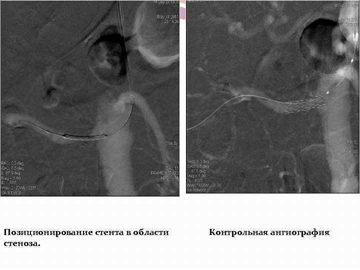 Позиционирование стента в области стеноза. Контрольная ангиография 