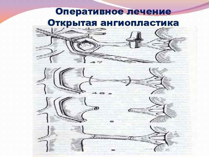 Оперативное лечение Открытая ангиопластика 