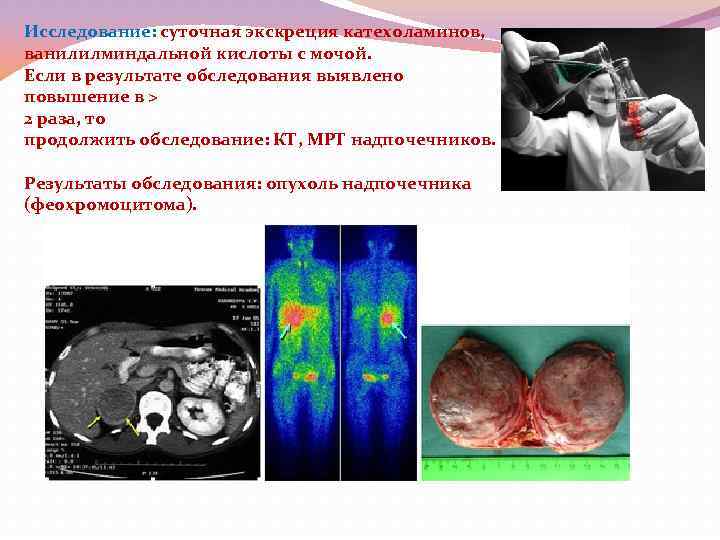 Исследование: суточная экскреция катехоламинов, ванилилминдальной кислоты с мочой. Если в результате обследования выявлено повышение