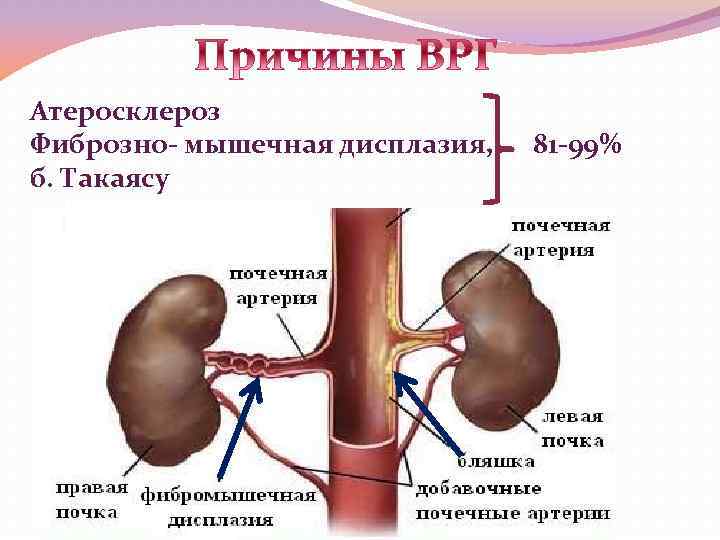 Атеросклероз Фиброзно- мышечная дисплазия, б. Такаясу 81 -99% 