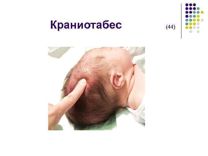  Краниотабес (44) 