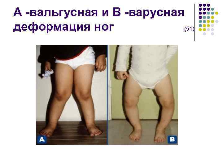 А -вальгусная и В -варусная деформация ног (51) 