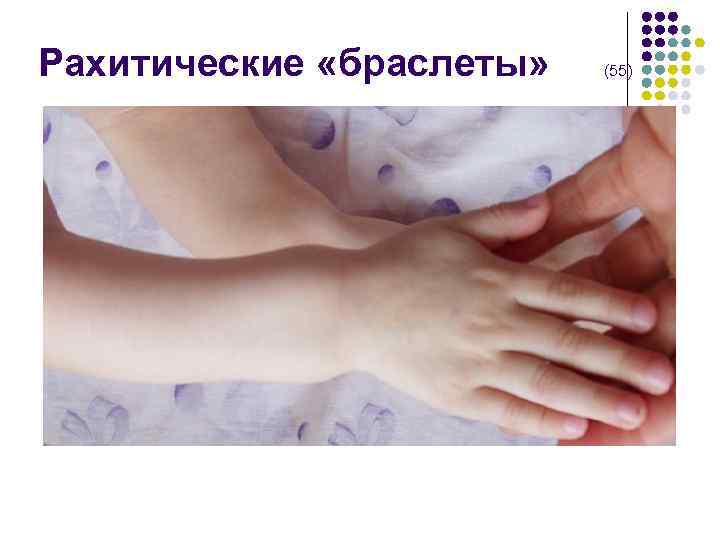  Рахитические «браслеты» (55) 