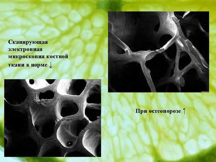 Сканирующая электронная микроскопия костной ткани в норме ↓ При остеопорозе ↑ 