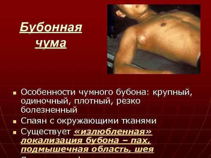 Бубонная чума n n n Особенности чумного бубона: крупный, одиночный, плотный, резко болезненный Спаян