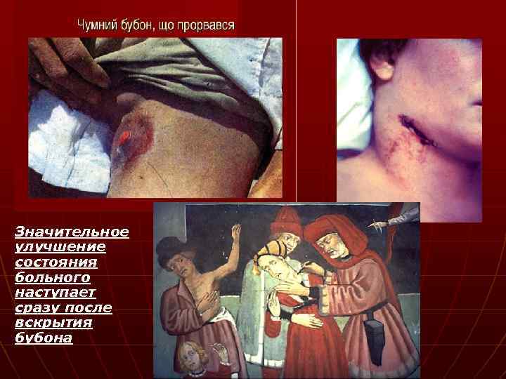 Значительное улучшение состояния больного наступает сразу после вскрытия бубона 