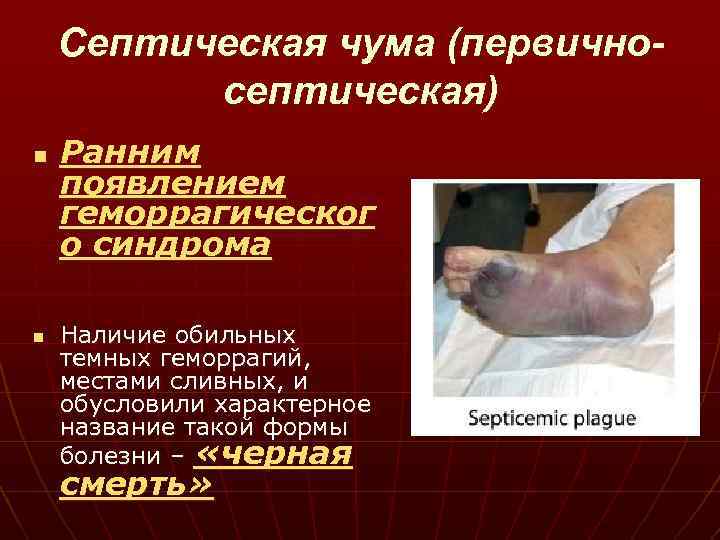 Септическая чума (первичносептическая) n n Ранним появлением геморрагическог о синдрома Наличие обильных темных геморрагий,