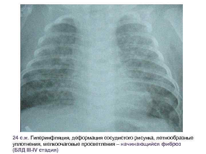 24 с. ж. Гиперинфляция, деформация сосудистого рисунка, летнообразные уплотнения, мелкоочаговые просветления – начинающийся фиброз