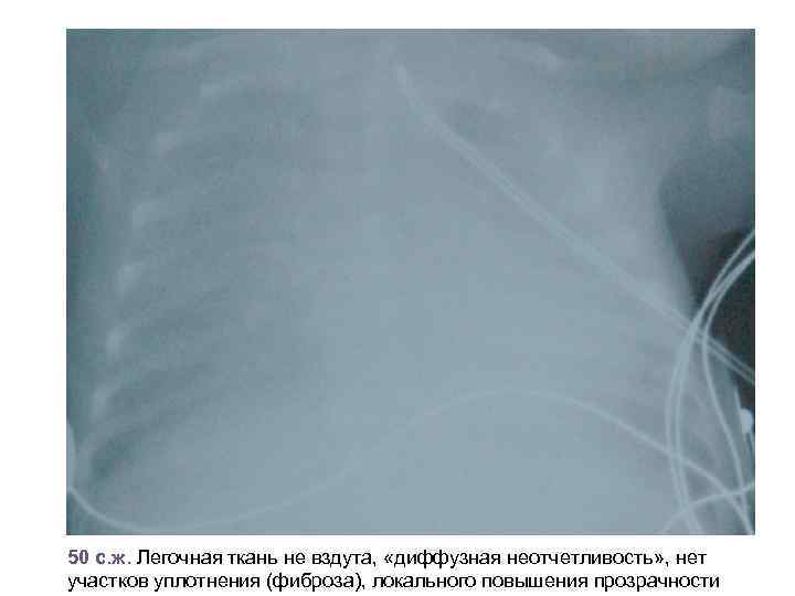 50 с. ж. Легочная ткань не вздута, «диффузная неотчетливость» , нет участков уплотнения (фиброза),