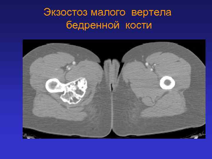 Экзостоз малого вертела бедренной кости 