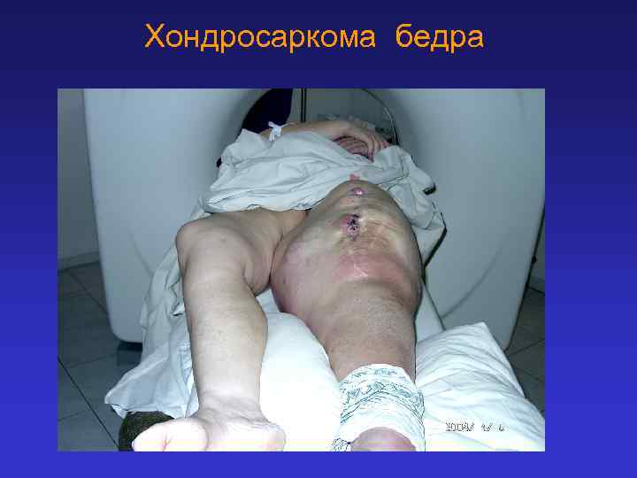 Хондросаркома бедра 