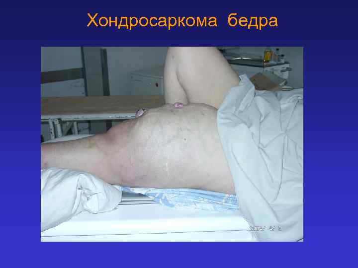 Хондросаркома бедра 