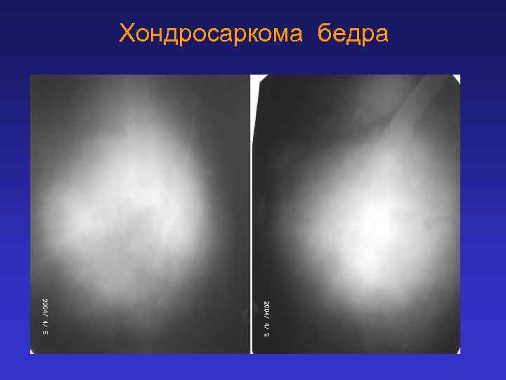 Хондросаркома бедра 