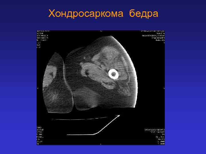 Хондросаркома бедра 