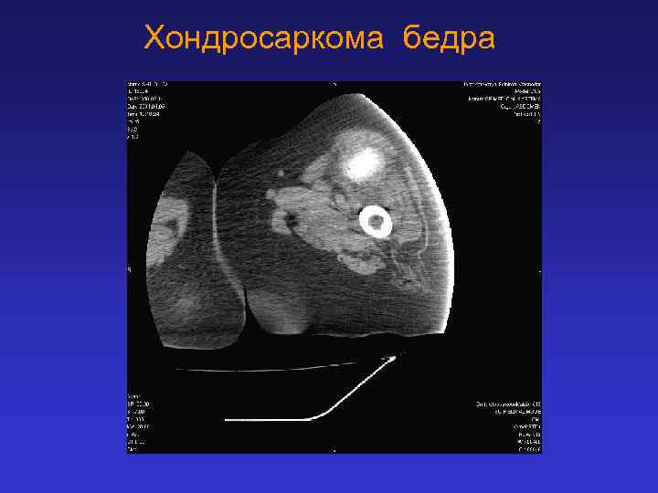 Хондросаркома бедра 