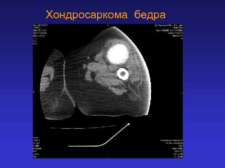 Хондросаркома бедра 