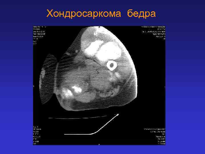 Хондросаркома бедра 