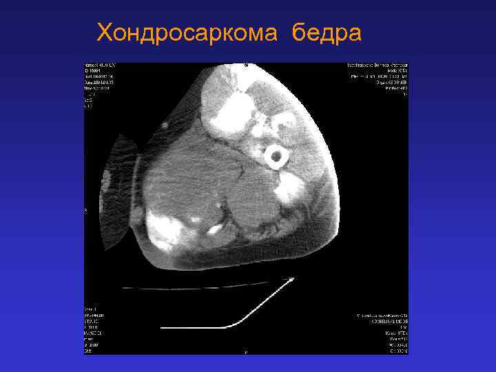 Хондросаркома бедра 