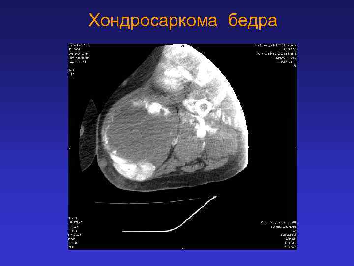 Хондросаркома бедра 