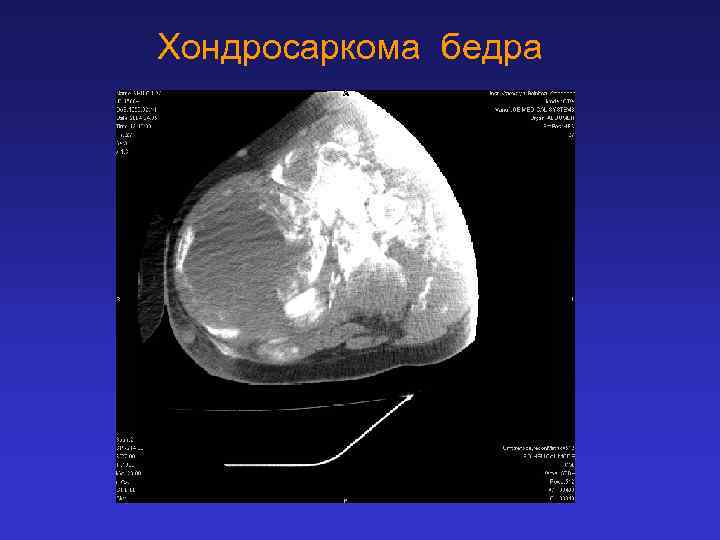 Хондросаркома бедра 
