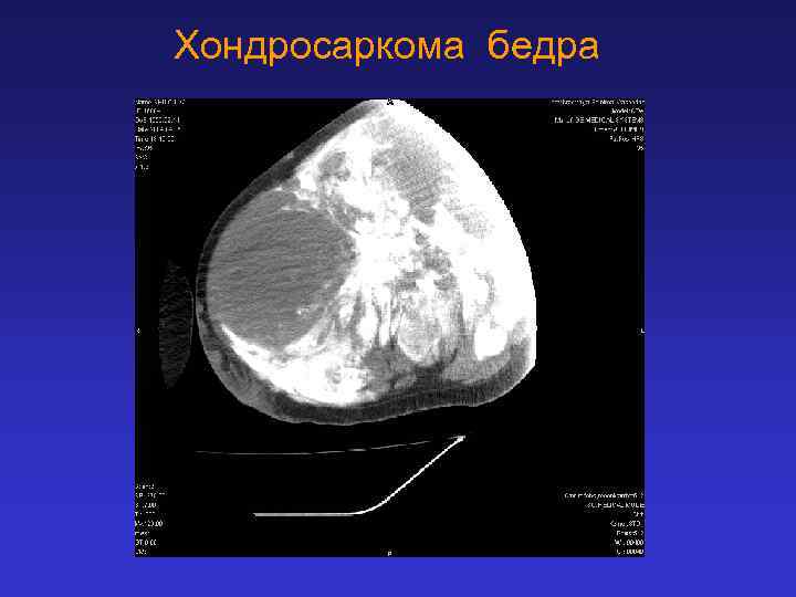 Хондросаркома бедра 