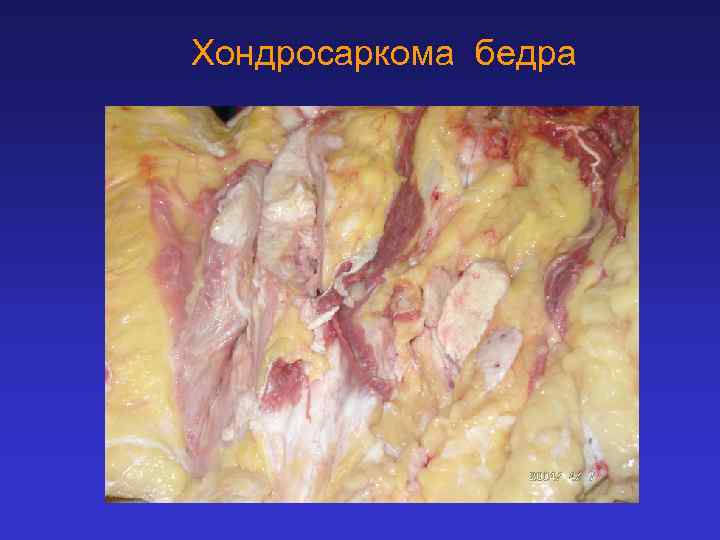 Хондросаркома бедра 