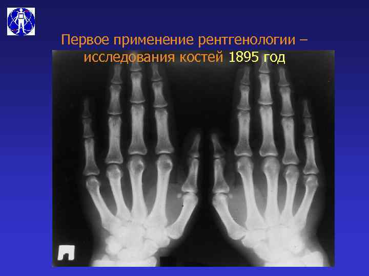 Первое применение рентгенологии – исследования костей 1895 год 