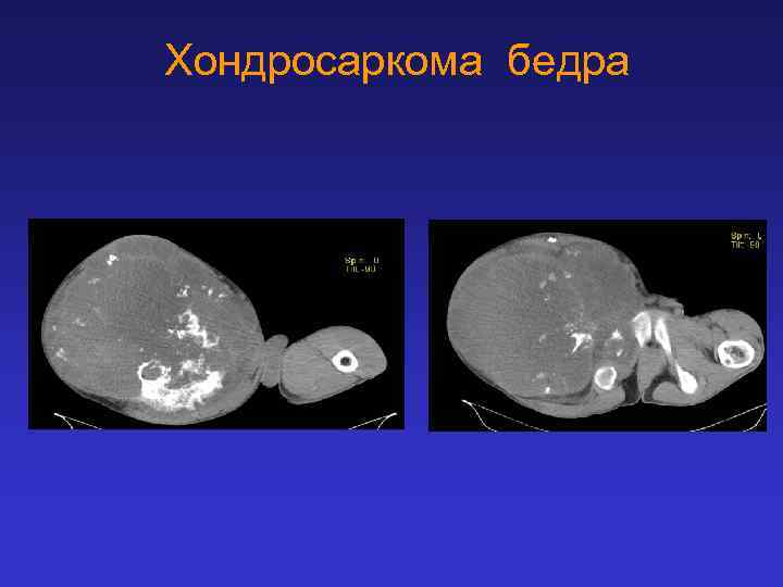 Хондросаркома бедра 