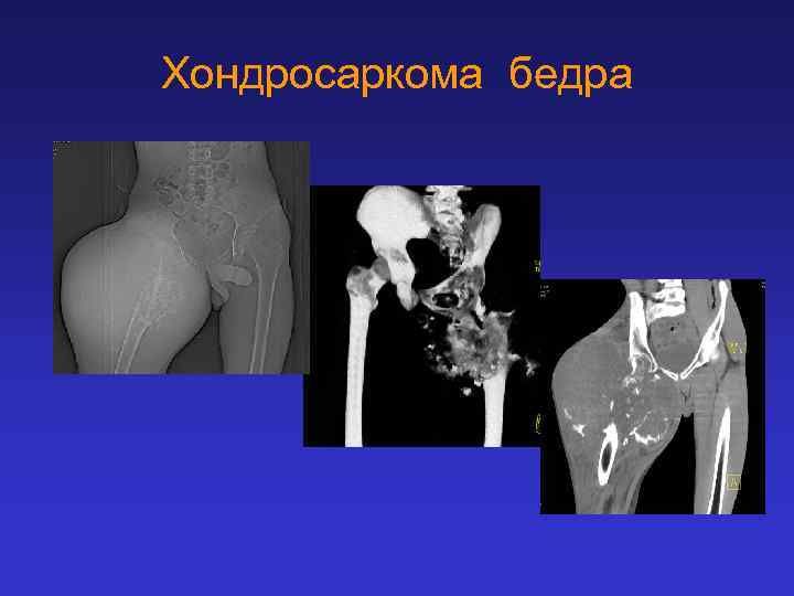 Хондросаркома бедра 
