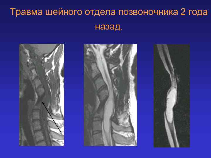 Травма шейного отдела позвоночника 2 года назад. 