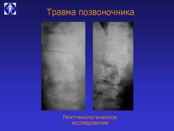 Травма позвоночника Рентгенологическое исследование 