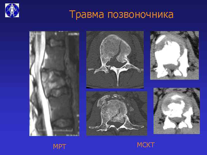 Травма позвоночника МРТ МСКТ 