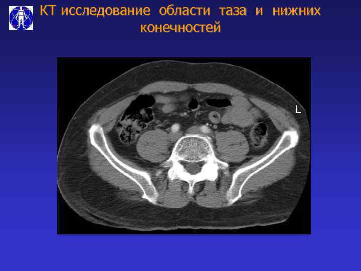 КТ исследование области таза и нижних конечностей 