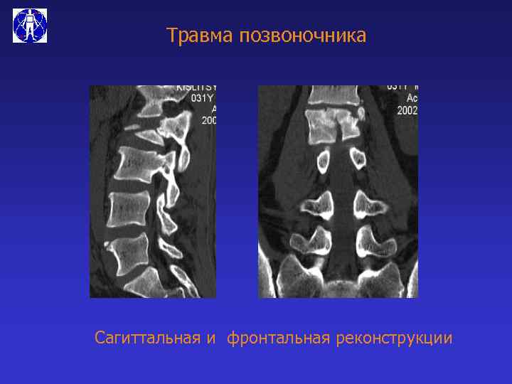 Травма позвоночника Сагиттальная и фронтальная реконструкции 