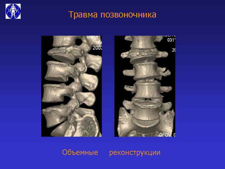 Травма позвоночника Объемные реконструкции 