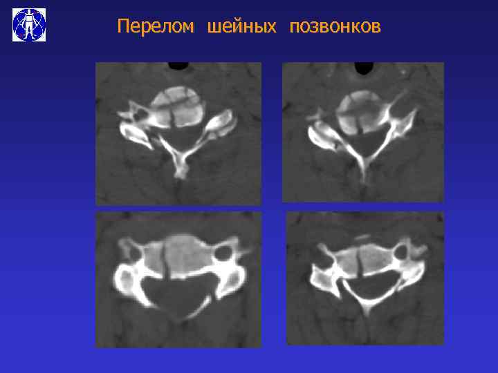 Перелом шейных позвонков 