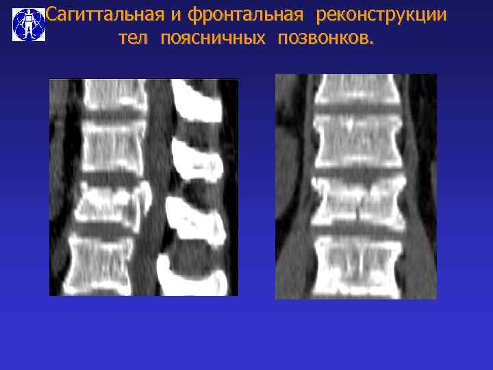 Сагиттальная и фронтальная реконструкции тел поясничных позвонков. 