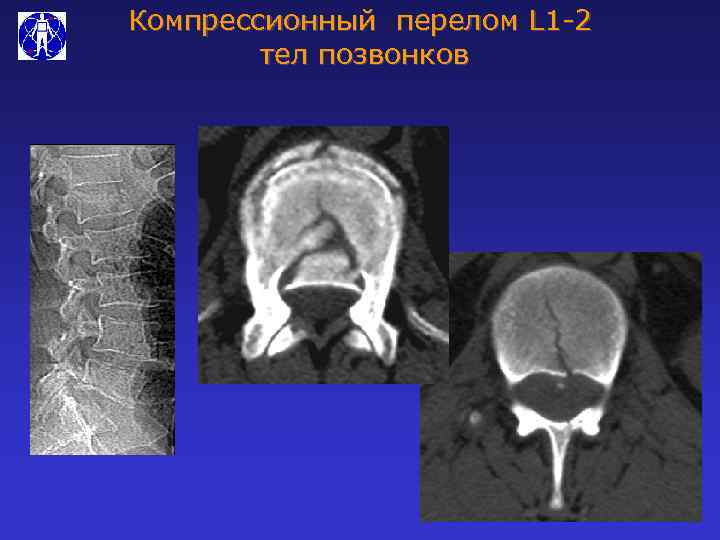 Компрессионный перелом L 1 -2 тел позвонков 