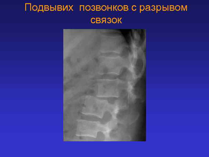 Подвывих позвонков с разрывом связок 