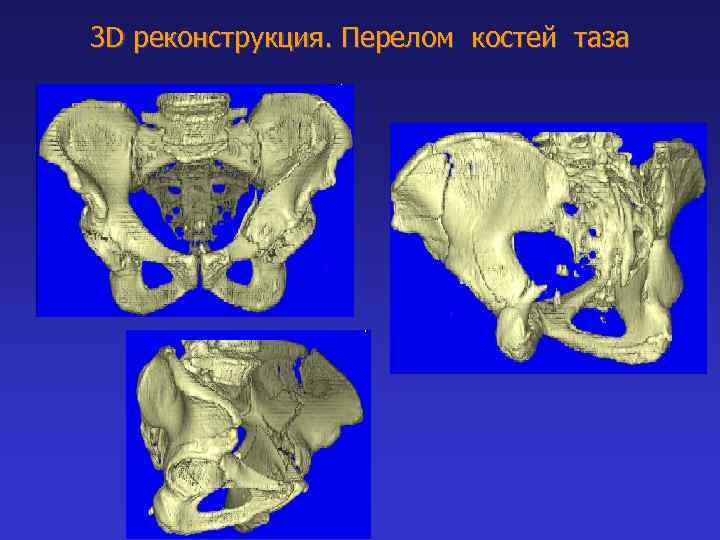 Три тазовые кости. Тазовая кость. Тазовая кость вид сверху. Лунные кости таза.