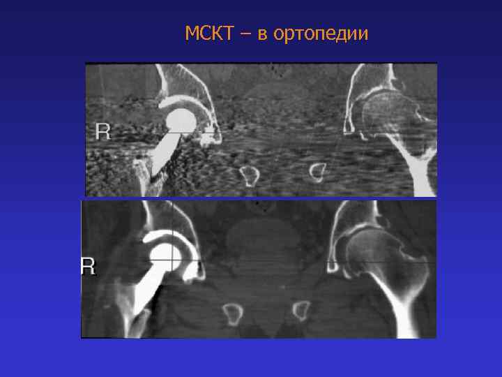 МСКТ – в ортопедии 
