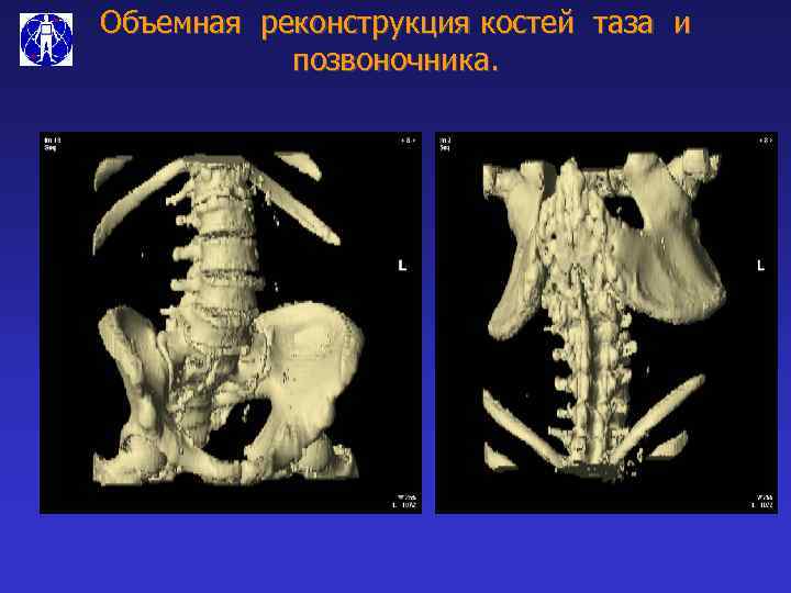 Объемная реконструкция костей таза и позвоночника. 