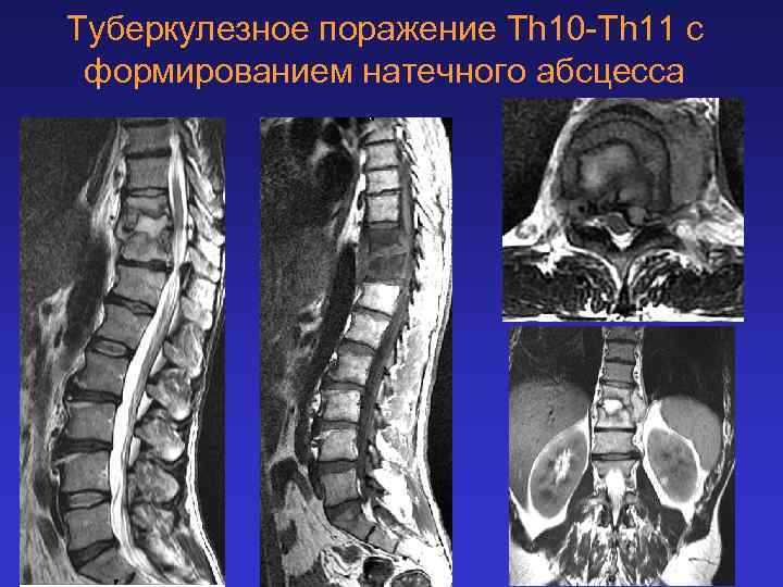 Туберкулезное поражение Th 10 -Th 11 с формированием натечного абсцесса 